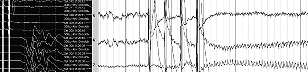 Intraoperative Neuromonitoring